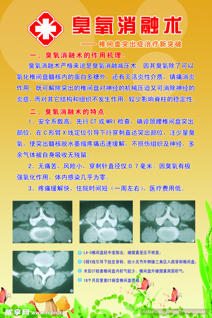 臭氧消融术