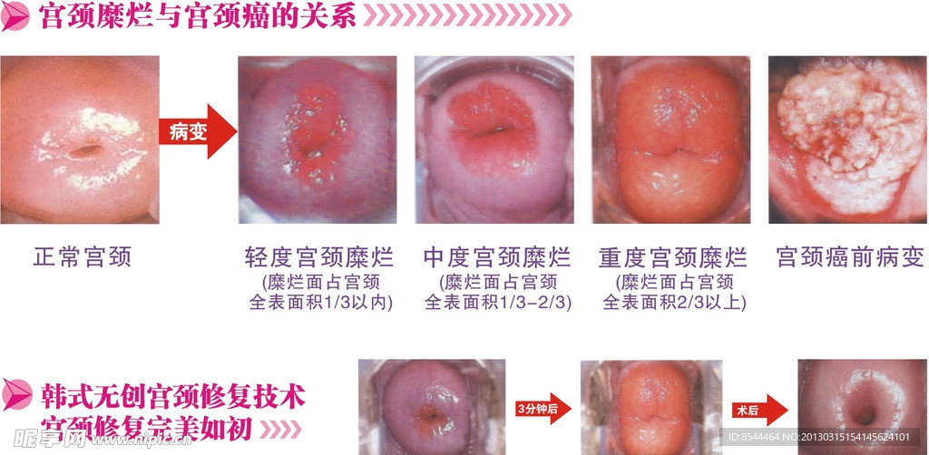 宫颈糜烂