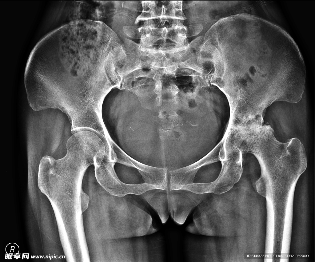 X线骨盆拍片