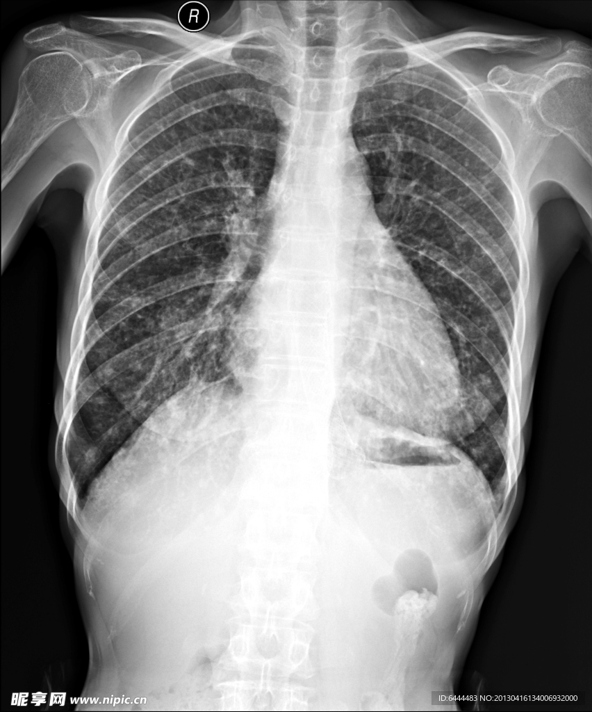 X线胸部拍片