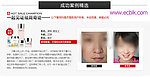 百莲凯祛斑效果图