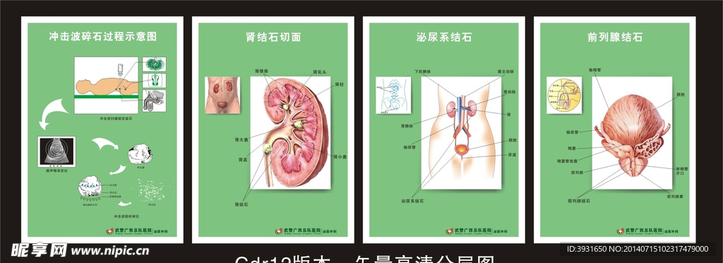 医院结石海报