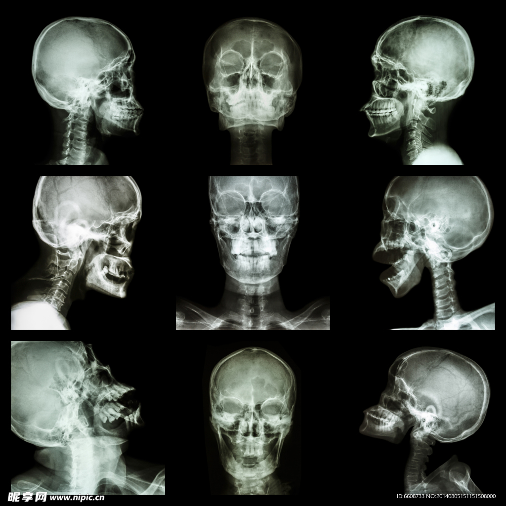 头部X光片