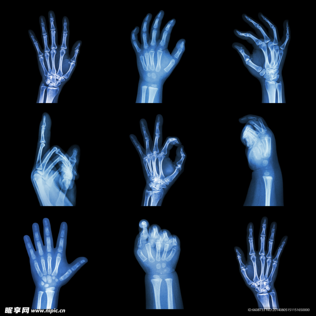 手部X光片