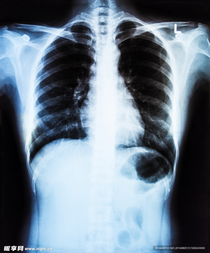 胸腔X光片
