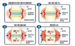 软骨退化示意图