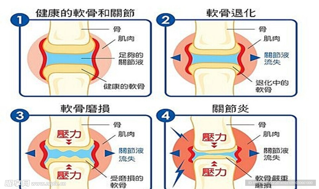 软骨退化示意图
