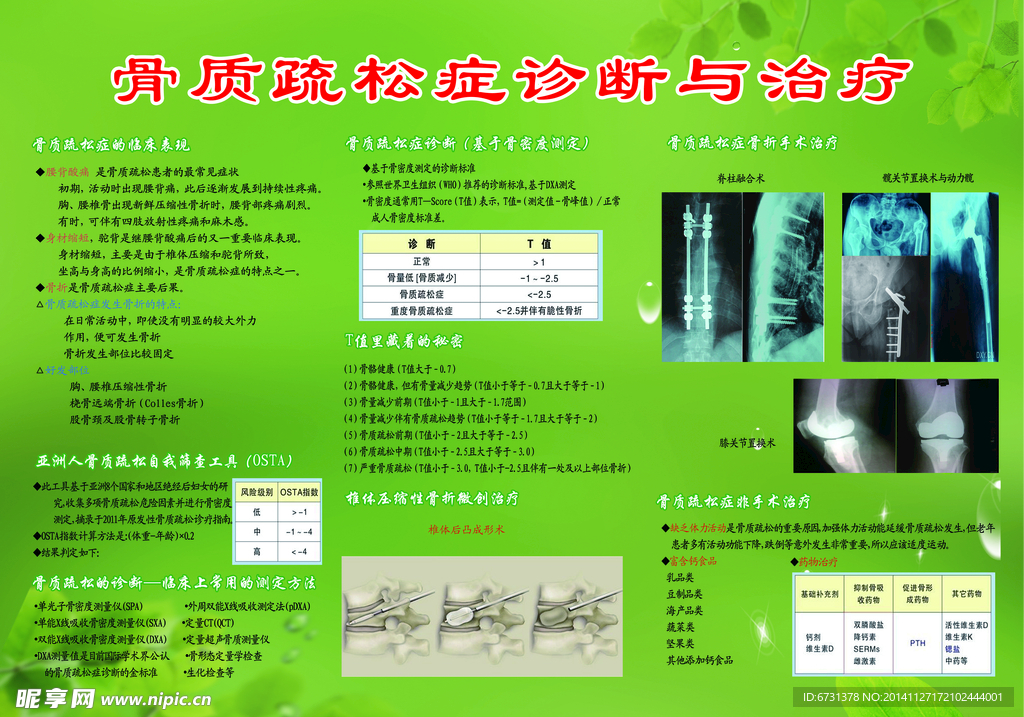 骨质疏松