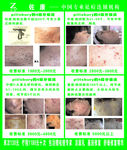 佐康祛痘等级分级法
