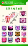 宫颈疾病海报