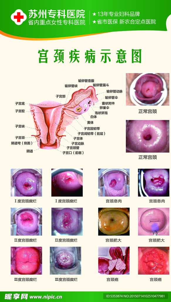 宫颈疾病海报