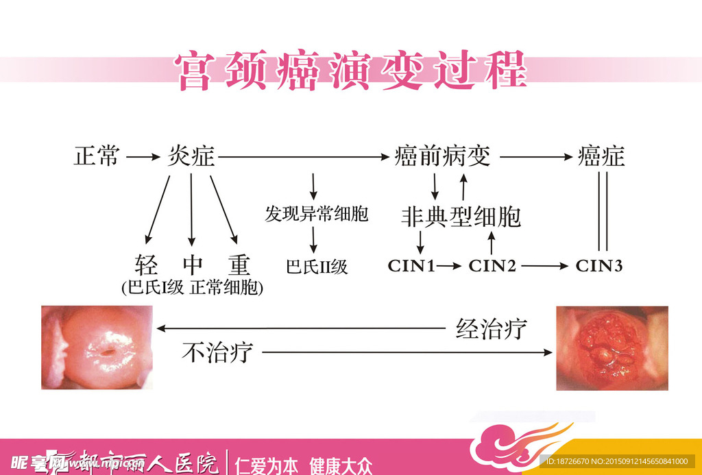 宫颈癌变过程 巴氏分级