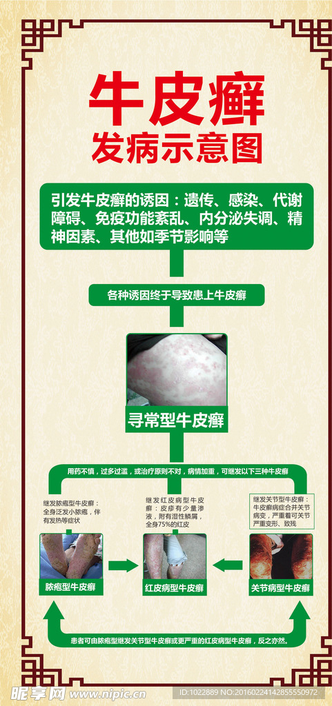 牛皮癣发病示意图