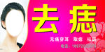 去痣