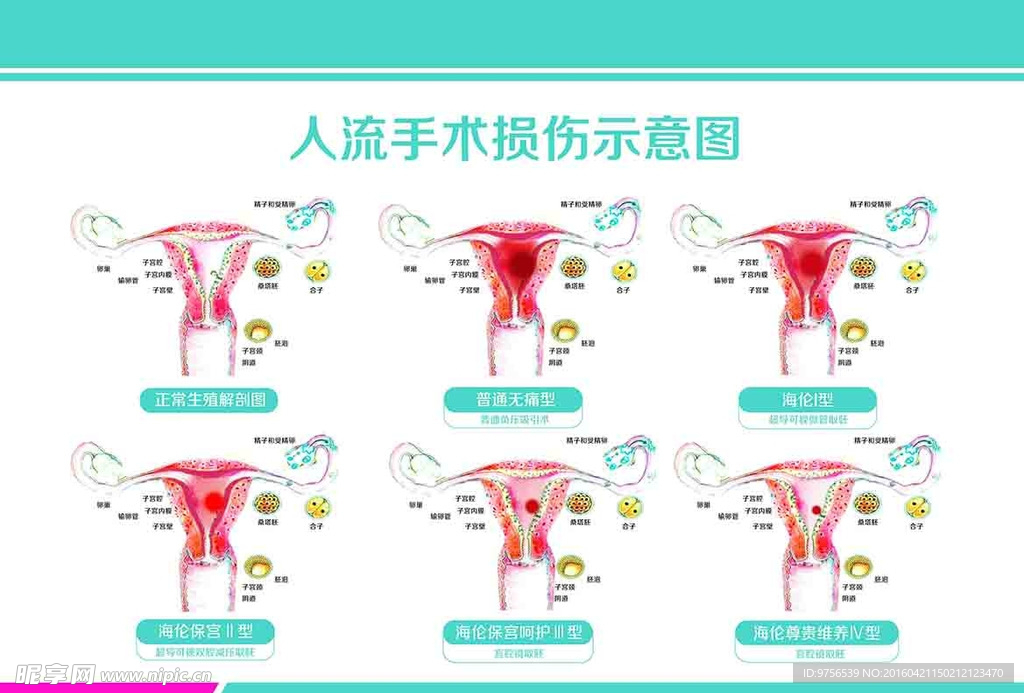 妇科人流手术损伤示意图