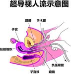 超导可视人流示意图