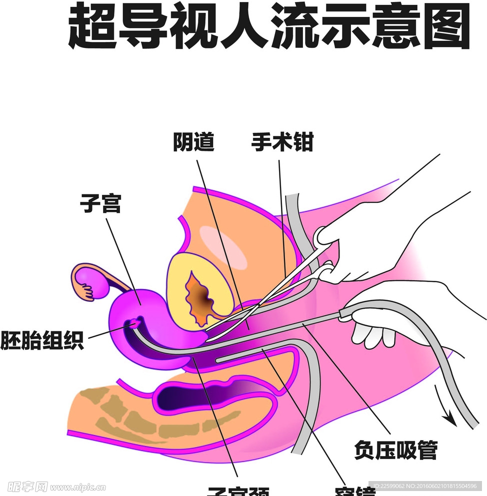 超导可视人流示意图