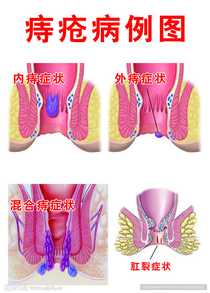 痔疮 病例图