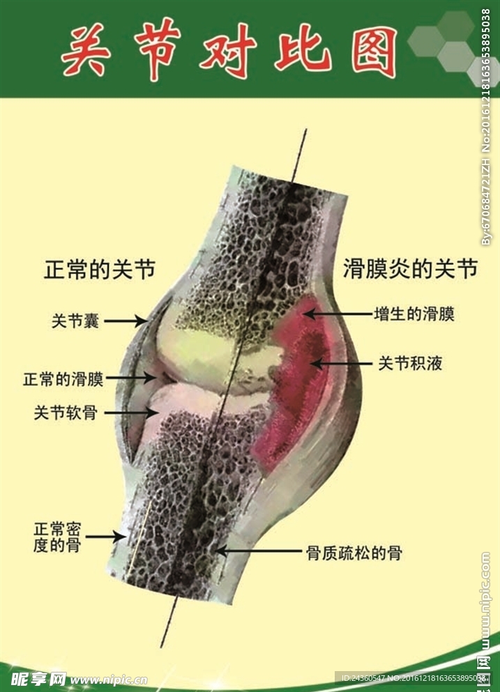 关节对比图