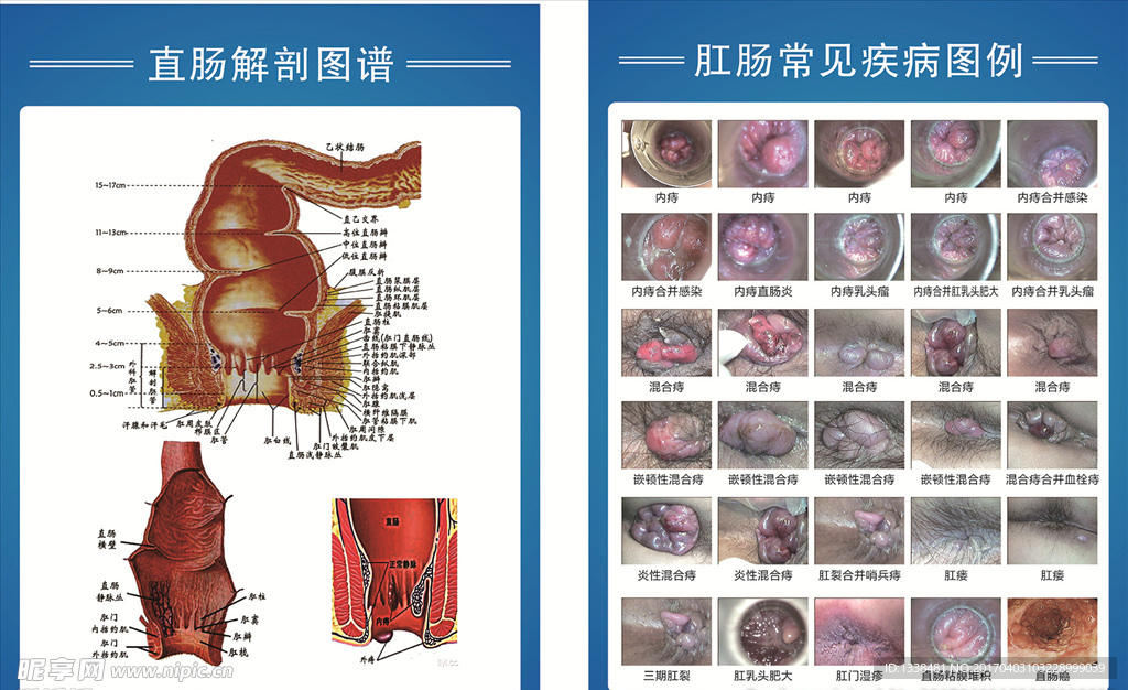 肛肠展板