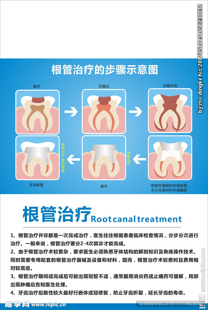 根管治疗