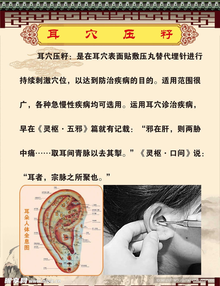 耳穴压籽