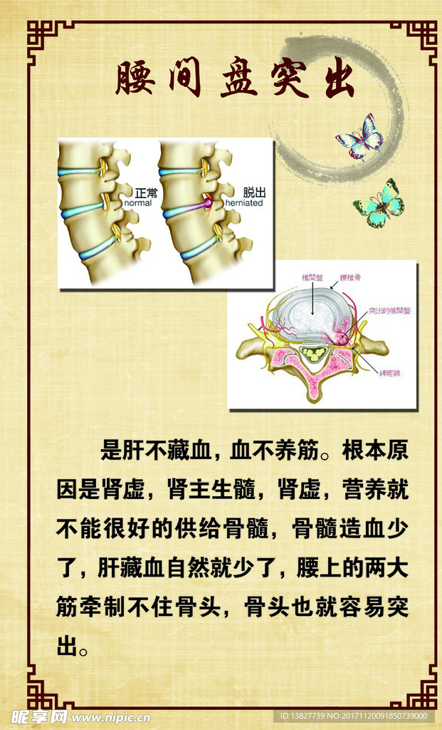 腰间盘突出 骨头 腰椎