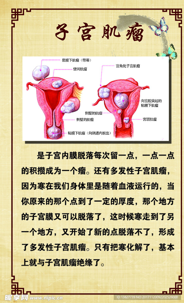 子宫肌瘤 妇科 关爱女性