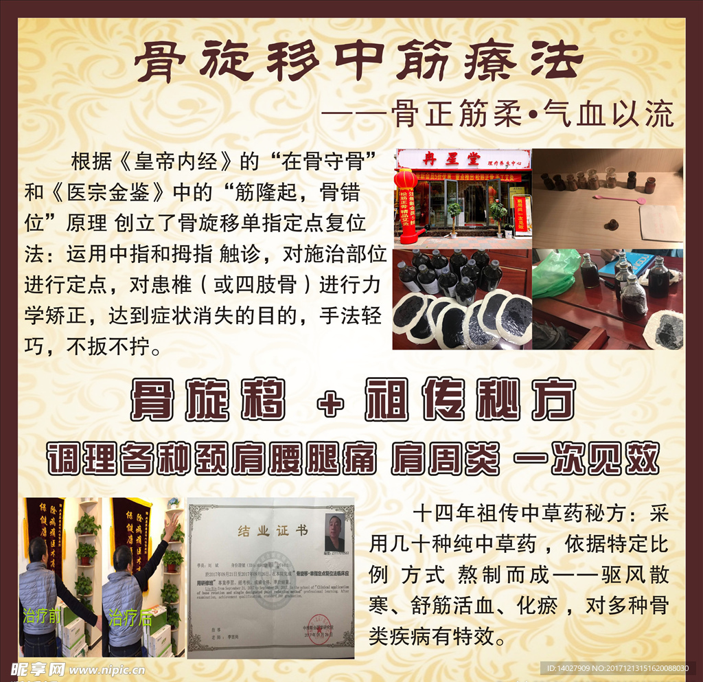 骨旋移中筋疗法