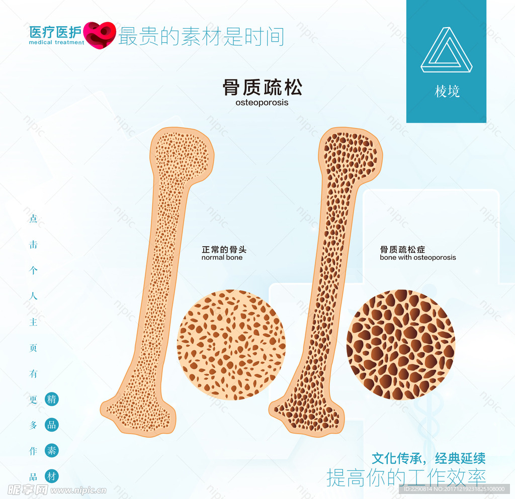 骨质疏松