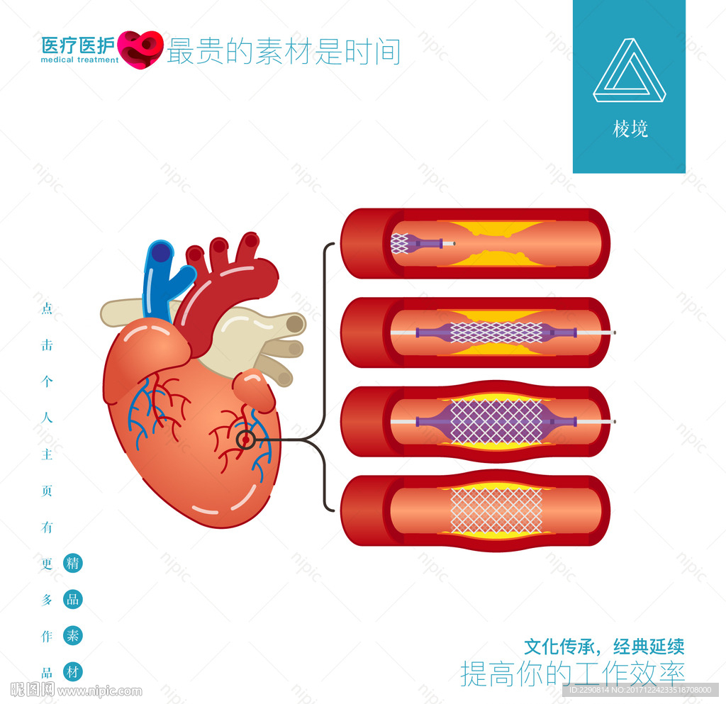 心脏支架