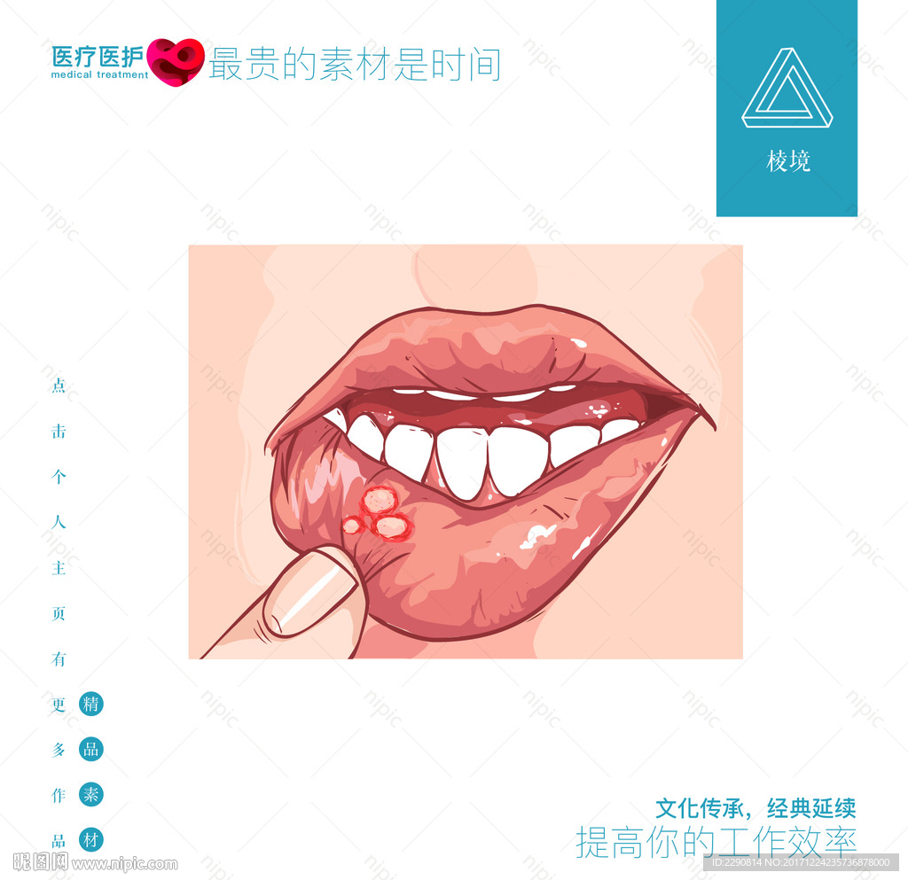 口腔溃疡