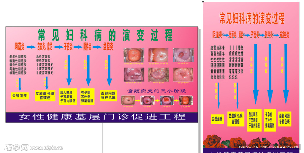 妇科病病变过程`