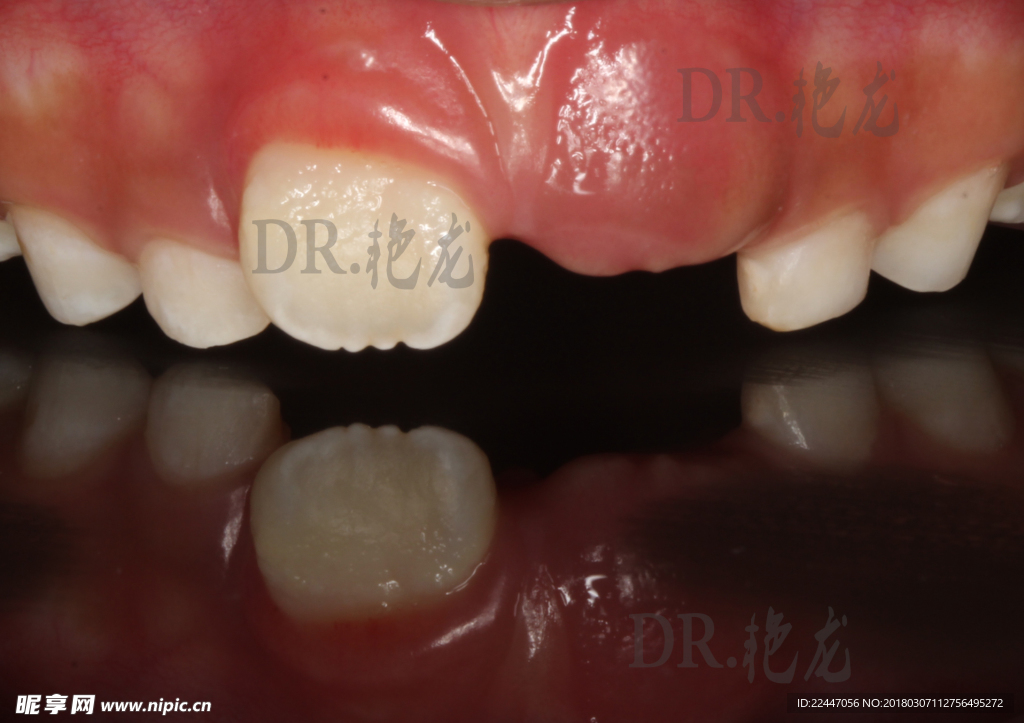 恒压萌出观察记录图