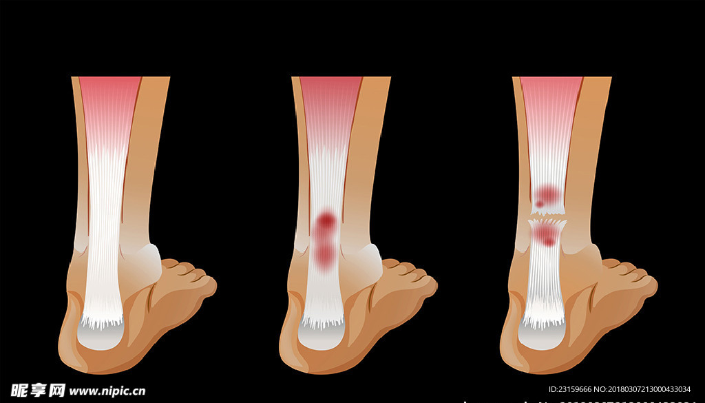 人脚骨折示意图