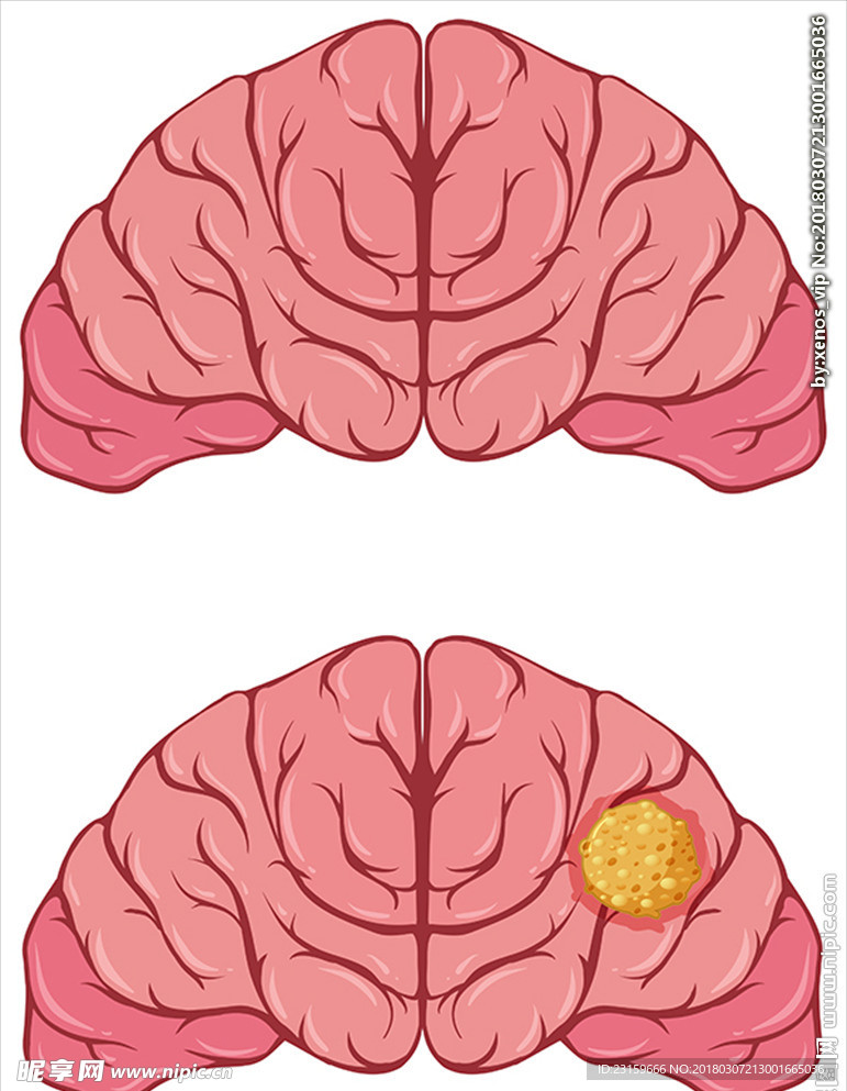 人类的大脑与癌症细胞插图