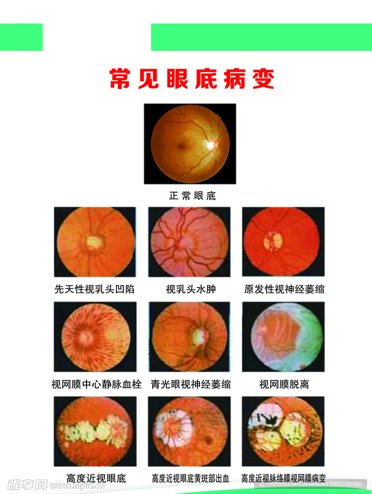 常见眼底病变