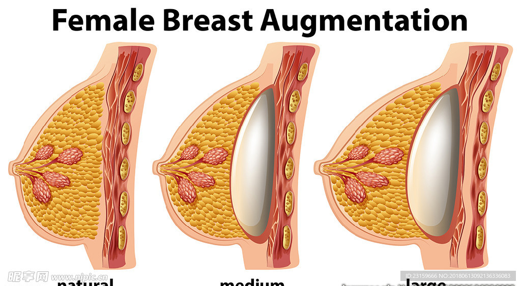 一组女性隆胸过程图