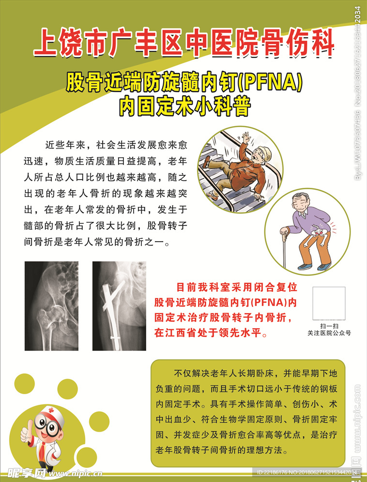 股骨近端方旋髓内钉内固定术海报