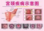 宫颈疾病示意图