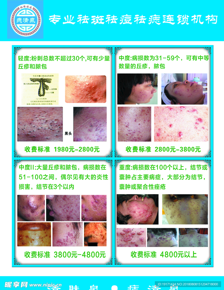 祛痘收费标准