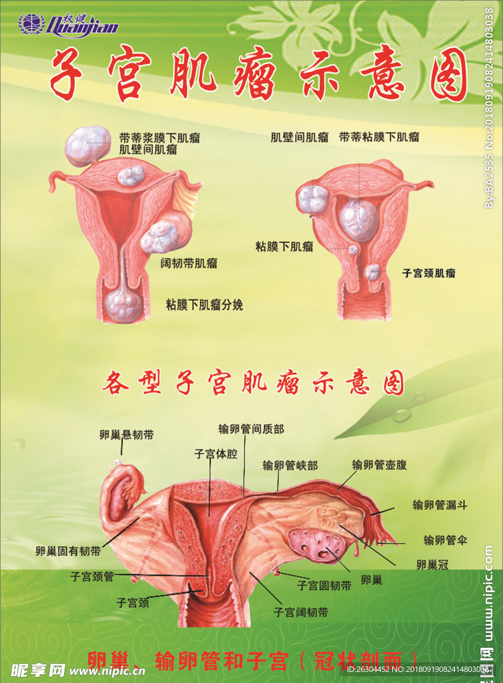 子宫肌瘤示意图