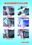 窝沟封闭的操作方法与步骤