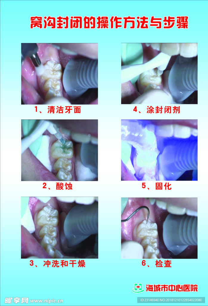 窝沟封闭的操作方法与步骤