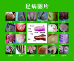 灰指甲