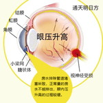 眼压升高