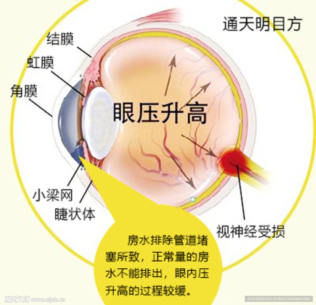 眼压升高