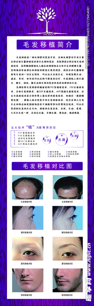 毛发移植