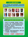 什么是灰指甲