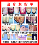 灰指甲
